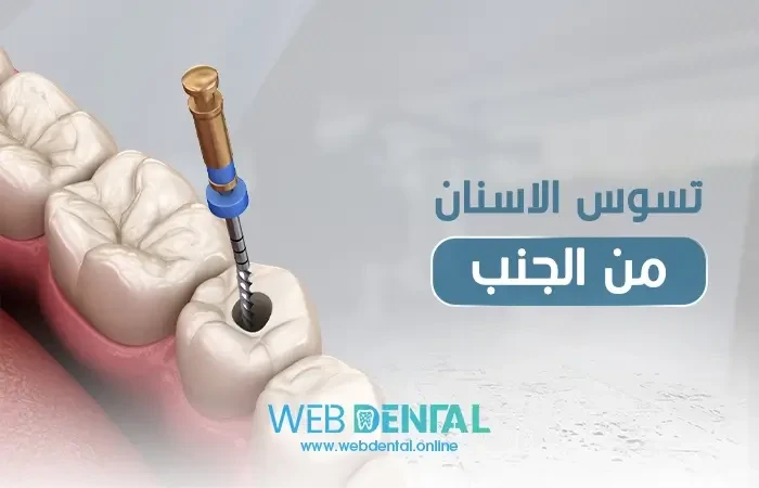 تسوس الاسنان من الجنب image