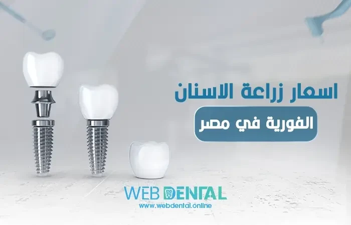 ما هي اسعار زراعة الاسنان الفورية في مصر image